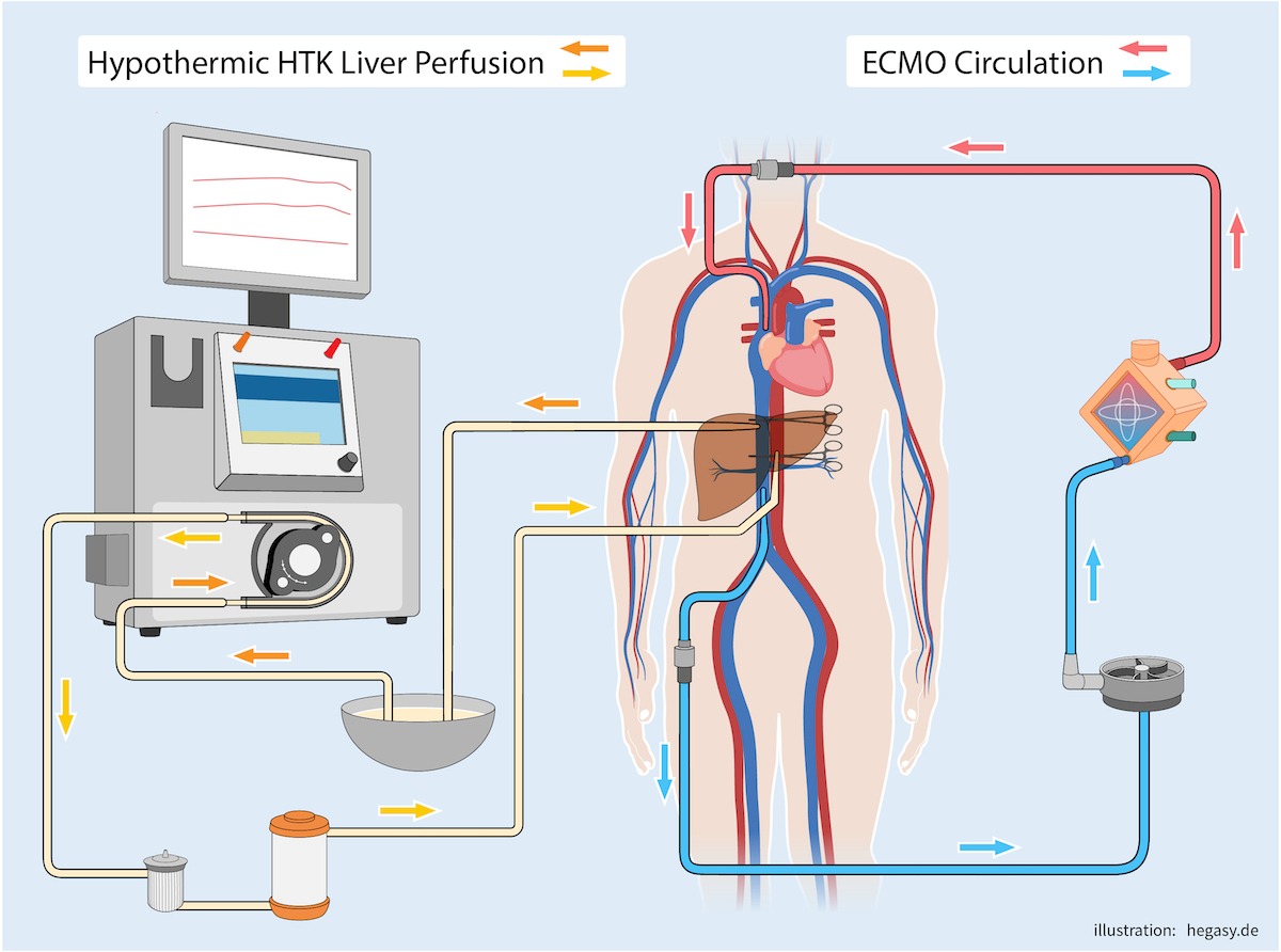 Medizinische Illustration eines neuen Operationsverfahrens mit einer gekühlten Leberperfusion links und einer ECMO rechts.